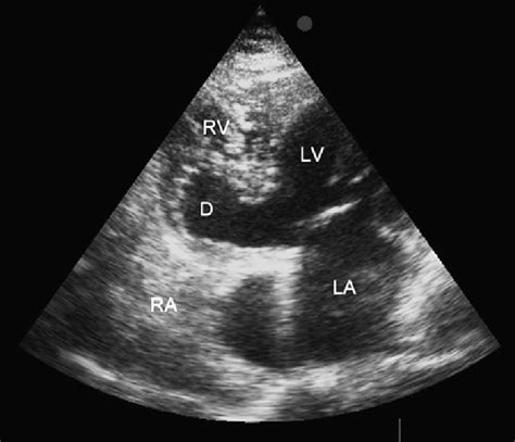 lv diverticulum|left ventricular diverticulum echo.